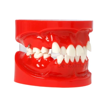 Ортодонтско лечение на зъбите Модел на зъбите за демонстрация на ортодонтско лечение 3005